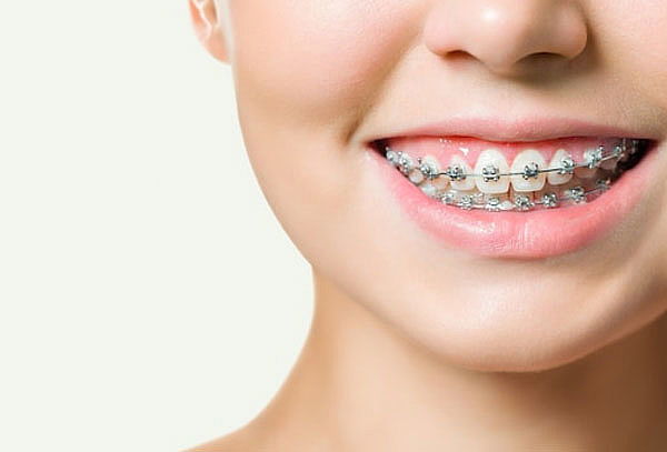 Corrige, Alinea y Transforma tu Sonrisa con Brackets