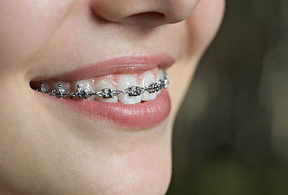 Colocación de Brackets Metálicos Mini + Limpieza