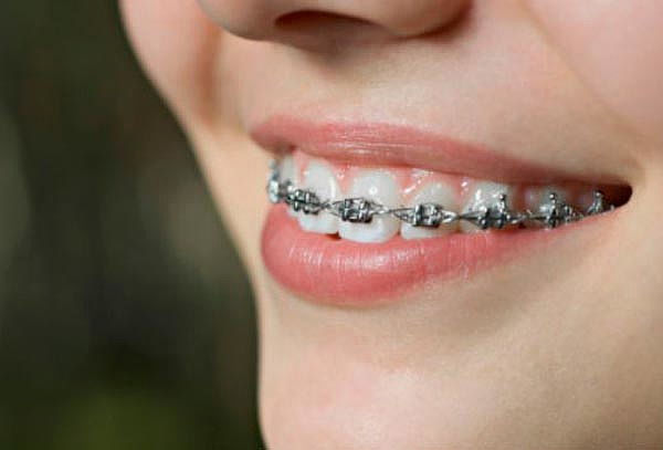 Brackets Metálicos Mini + Limpieza en RL Orthodontics Roma