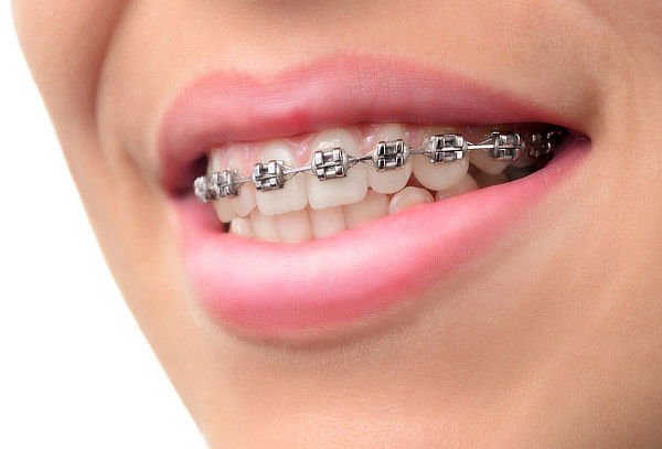 Colocación Brackets Estéticos Invisibles + Limpieza Dental
