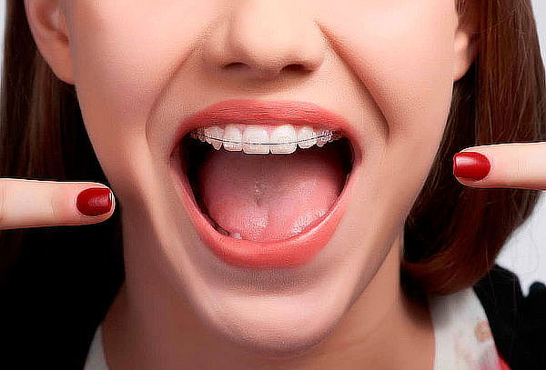 Instalación de Brackets Miniatura a elegir + Limpieza Dental