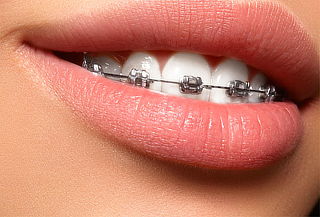 Brackets mini metálicos ó Invisibles + Limpieza y mas.