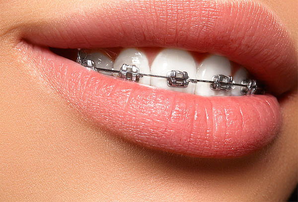 Brackets mini metálicos ó Invisibles + Limpieza y mas.
