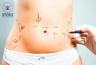 Lipoescultura Ultrasónica Externa 
