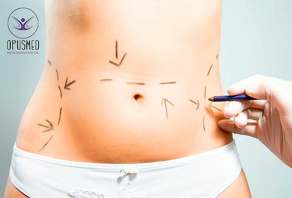Lipoescultura Ultrasónica Externa 