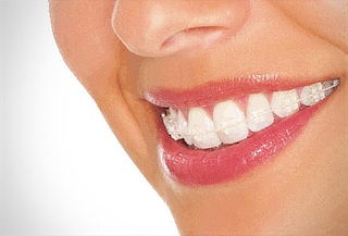 Brackets Estéticos Invisibles o Miniatura 96%