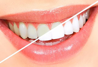 4 Sesiones de Blanqueamiento + Profilaxis y Más