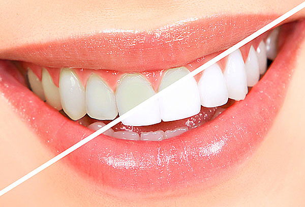 4 Sesiones de Blanqueamiento + Profilaxis y Más
