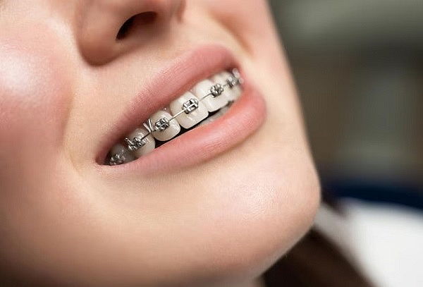 Brackets metálicos + Limpieza (Ultrasonido)