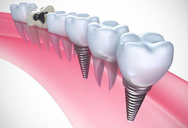 Implante Dental de Titanio en Virtual Dent