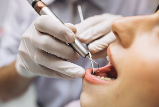 Despistaje de Caries + Profilaxis + 4 Sellantes 3M