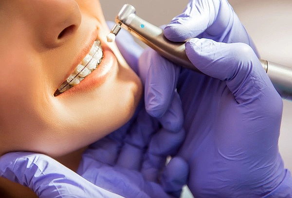 Profilaxis + Destartaje + Fluorización + Consulta