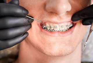 ¡Brackets o Mini Brackets Metálicos + Instalación y Más!