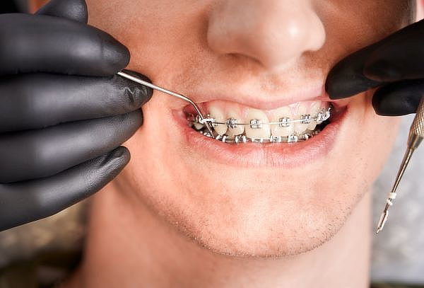 ¡Brackets o Mini Brackets Metálicos + Instalación y Más!