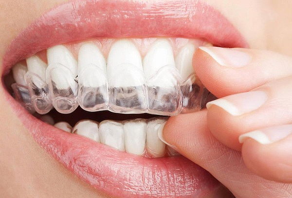 Férula de Blanqueamiento + Profilaxis + Consulta y más