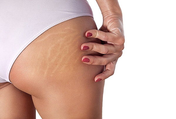 Tratamiento Avanzado para Estrías con Fibroblast Plasmapen