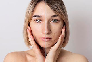 Limpieza Facial Profunda ANTIACNÉ  + Peeling y Más