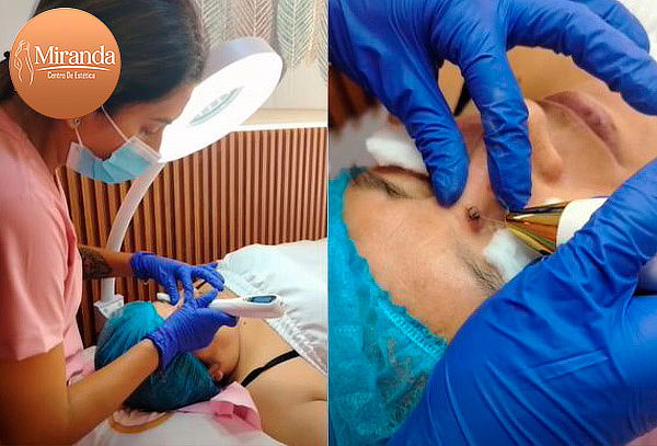 Eliminación de 3 o 5 Acrocordones en 1 Sesión – S/34.90
