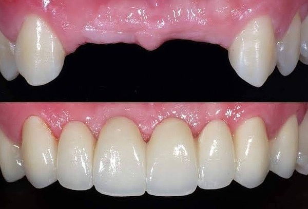 Consulta de Prótesis Dental + S/200 de Descuento