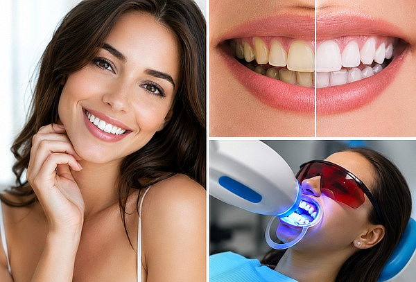 Sesión de Blanqueamiento dental  + Profilaxis