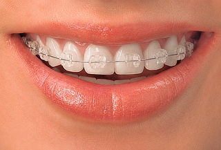 Evaluación para Brackets ¡Empieza tu Cambio de Sonrisa! 