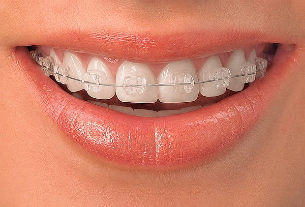 Evaluación para Brackets ¡Empieza tu Cambio de Sonrisa! 