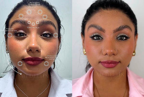 ¡Rejuvenece! Toxina Botulínica Desde 01 zona a Elegir