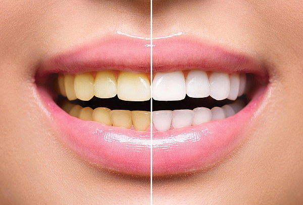 2 Sesiones de Blanqueamiento dental + Profilaxis + Flúor