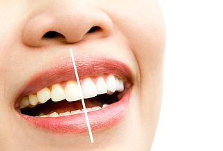 2 Sesiones Blanqueamiento dental + Flúor + Profilaxis