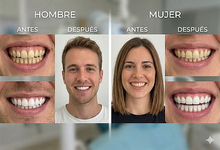 Limpieza Dental Premium + 2 Sesiones Blanqueamiento LED