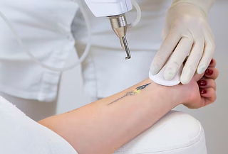 Remoción de Tatuaje: 1 Sesión De Láser Q-Switched