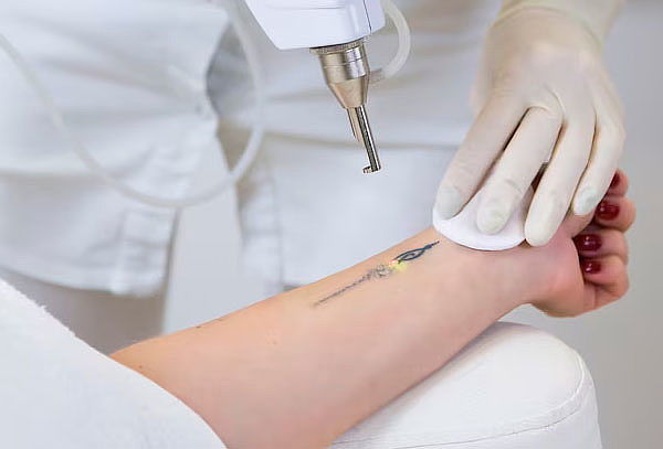 Remoción de Tatuaje: 1 Sesión De Láser Q-Switched