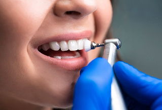 Limpieza Dental Profesional + Flúor