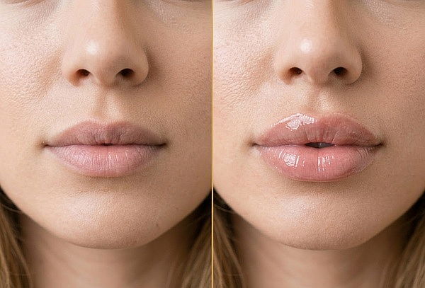 1 Sesión de Aumento de labios con Ácido Hialurónico