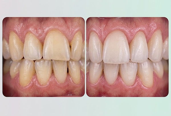 Reparación de cuellos dentales