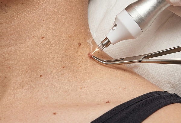 Eliminación de verrugas del cuello