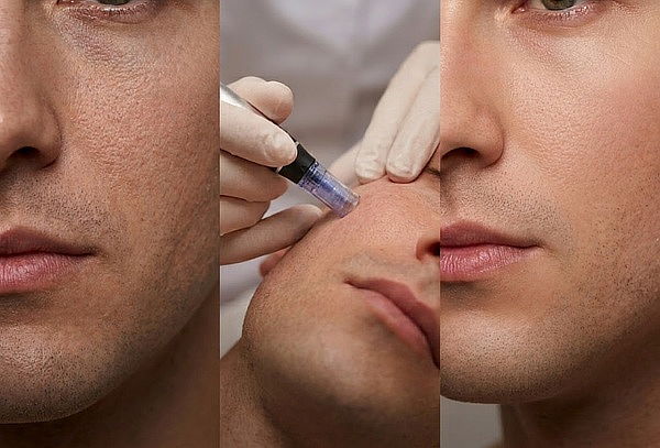 Sesión Glow Facial para Caballeros, Dermapen y más