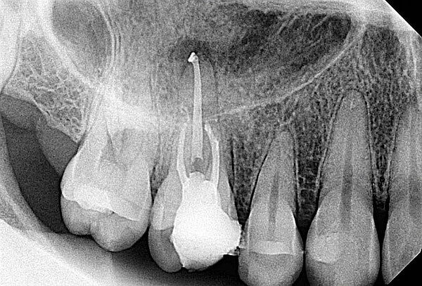 Endodoncia en 1 sola cita con microscopio